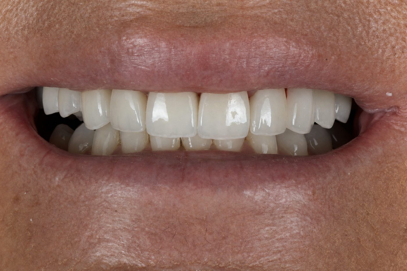 After: porcelain veneer smile makeover by Dr. Seth Calish, Clermont FL