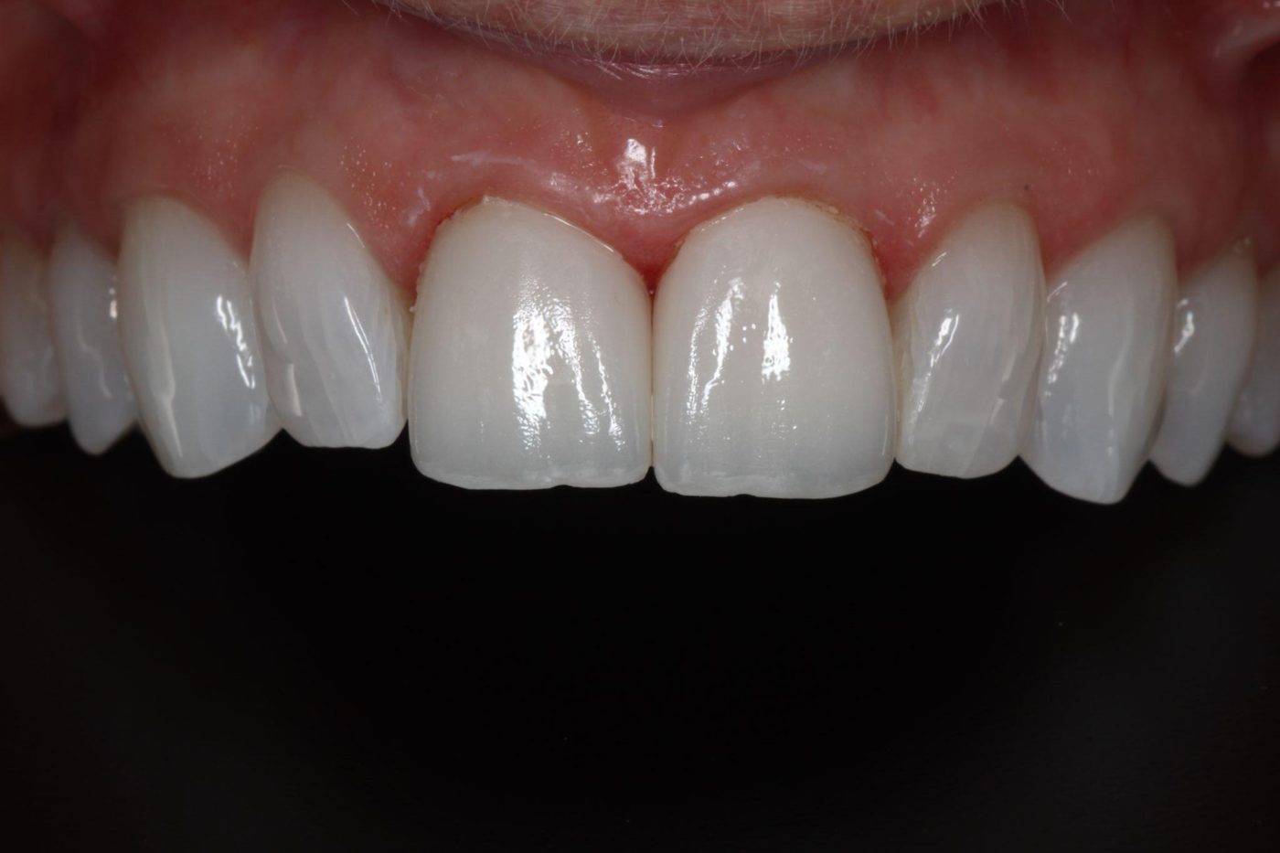 After: front tooth restored to match neighboring teeth invisibly, Clermont FL