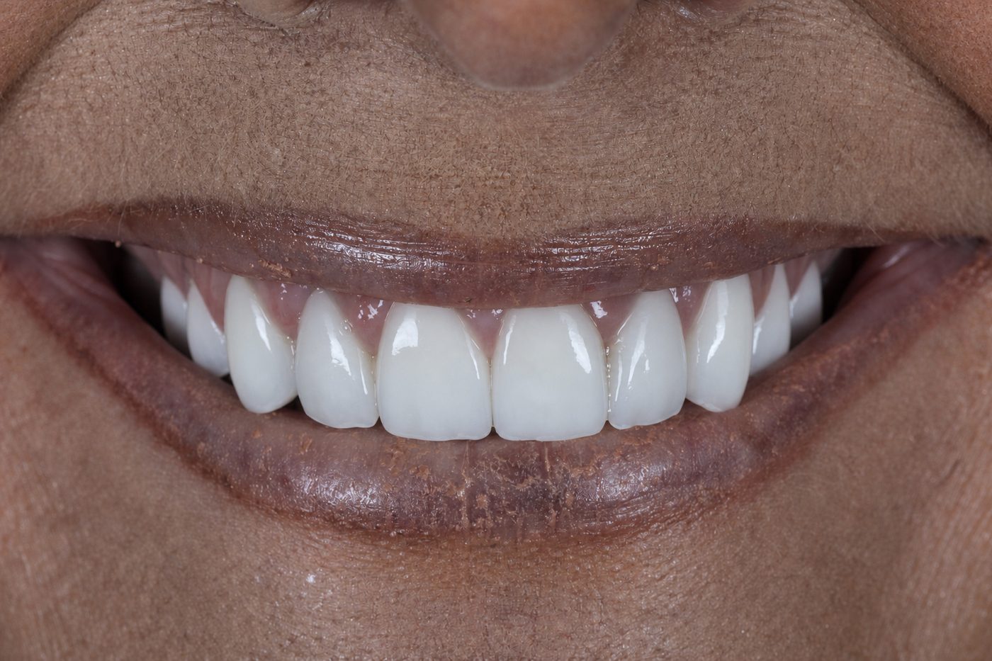 After: natural porcelain veneers by Dr. Seth Calish, Clermont FL