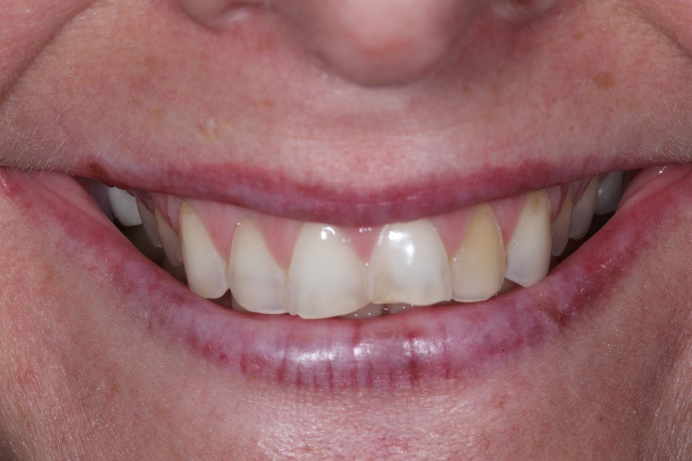 Before: worn, discolored smile before porcelain veneers, Clermont FL