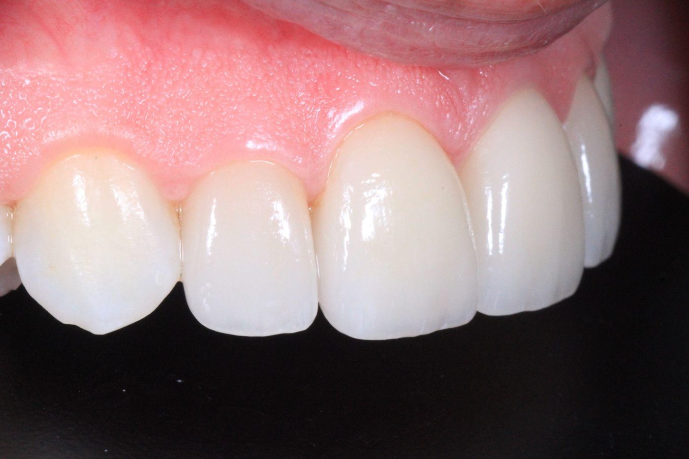 Close-up of layered porcelain veneer detail crafted for a patient of Dr. Seth Calish, Clermont FL