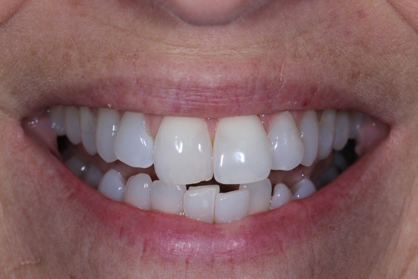 Before: crowded teeth before clear aligners, Clermont FL